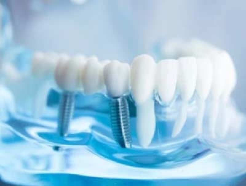 Consulta em Clínica Odontológica Implantes Jardim Santa Terezinha - Clínica Odontológica 24h