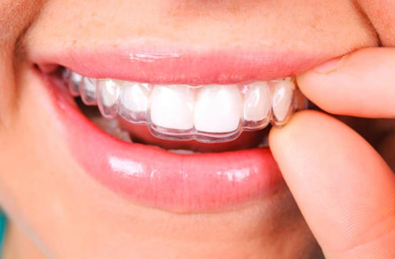 Implantes de Dentadura Distrito Industrial - Tratamento de Canal Dentário Sumaré