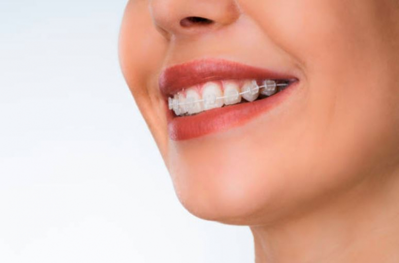Qual o Valor de Mini Implante Ortodôntico Santa Cruz - Aparelho Odontológico Hortolândia